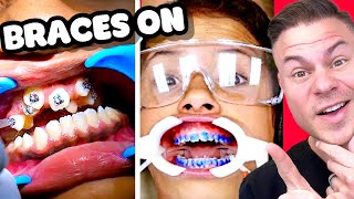 How Braces Are Put On  Watch Before You Get Braces [upl. by Adnuhsat]