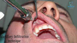 Maxillary Infiltration anesthesia technique  Local anesthesia for maxillary teeth [upl. by Newcomer]