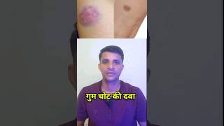 गुम चोट की दवा।। thrombophob gel  thrombophob cream kis kaam aati hai [upl. by Katzir]