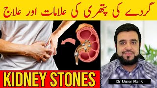 Gurde Mein Pathri Ki Alamat Gurday Ka Dard Gurde me Stone Kidney Stones Ka Ilaj Pathri Ka Ilaaj [upl. by Githens985]