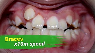 Braces 3 year  x10 milion speed [upl. by Sidonnie760]