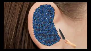 Itchy  Ear Stone Removal  Super Big Earwax  ASMR Animation TalesOfTingles [upl. by Acirea]