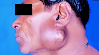 Tuberculous Abscess of Parotid Gland [upl. by Pride]