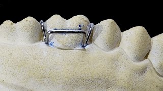 Orthodontic Wire Bending Adams Clasp [upl. by Plossl988]