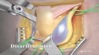 Peroneal and Tibial Intraneural Ganglion Cysts in the Knee Region Video 3 [upl. by Fazeli]