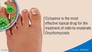 Ciclopirox is the most effective topical drug for the treatment of mildtomoderate Onychomycosis [upl. by Moreen]