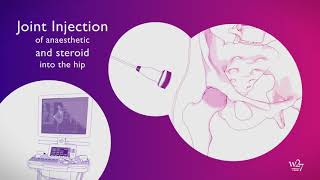 W27 UltrasoundGuided Hip Joint Injections [upl. by Brawner]