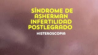 Síndrome de Asherman  Infertilidad Post legrado Histeroscopia [upl. by Gnemgnok]