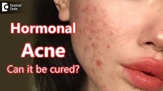 Can Hormonal Acne be cured  Dr Rasya Dixit [upl. by Kronick261]