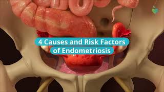 4 Causes and Risk Factors of Endometriosis [upl. by Ann]