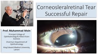 Corneoscleralretinal tear How to achieve successful outcome [upl. by Pierrette]