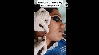 Removal of mole by radiofrequency I Skin Care [upl. by Lakym]