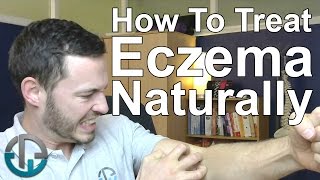 How To Treat Eczema Naturally [upl. by Attlee]