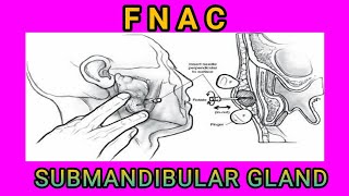 FNAC OF SUB MANDIBULAR GLAND।। fnaccytopathology [upl. by Nicolais]