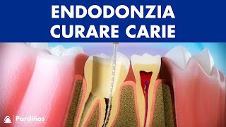 Endodonzia – Curare carie profonda © [upl. by Eralc]