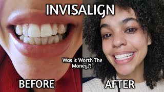 My Invisalign Journey [upl. by Baese71]