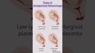 Types of Antepartum Hemorrhage  antepartumhemorrhage viralvideo [upl. by Blondelle]