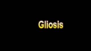 What Is The Definition Of Gliosis  Medical Dictionary Free Online Terms [upl. by Long844]