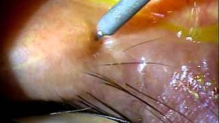 Dry Eye Syndrome Silicon Punctal Plug insertion [upl. by Enoryt187]