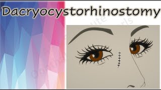 Dacryocystorhinostomy  DCR [upl. by Annoek]