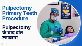 Pulpectomy Primary Teeth Procedure  Pulpectomy के बाद दांत लगवाना [upl. by Alis]