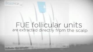 Baja Hair Center Boasts FUE Follicular Unit Extraction [upl. by Ahsinawt]