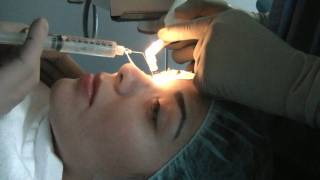 PRK Laser Refractive Surgery  Part 1 of 2 [upl. by Marilou]