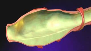 Bronchiectasis Animation  What is Bronchiectasis Videomp4 [upl. by Grania788]