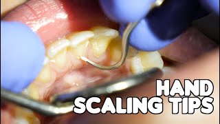 Dental Cleaning  Hand Scaling Tips [upl. by Eisteb]