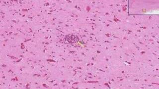 Histopathology Brain Viral encephalitis [upl. by Bullough]