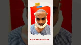 Amazing Hair Transplant 💥  Hair Density 😮hairtransplant hairfall shorts newvideo 2024 fue [upl. by Leuqram]