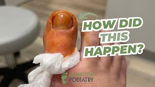 Partial TOENAIL Removal [upl. by Don971]