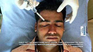 Regional Nerve Block for Scalp  Local Anaesthesia for PRP amp other scalp procedures [upl. by Nodyarb]