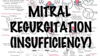 Mitral Reguritation insufficiency  Overview signs and symptoms pathophysiology treatment [upl. by Ymarej]