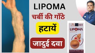 Lipoma ki best homeopathy medicine । लिपोमा ठीक करे बिना ऑपरेशन । [upl. by Yatnoj]