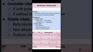 Ventricular Tachycardia [upl. by Iramaj]