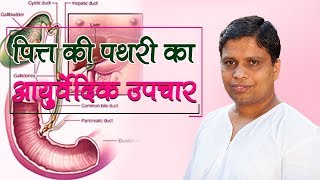 पित्त की पथरी का आयुर्वेदिक उपचार  Acharya Balkrishna [upl. by Aeikan]