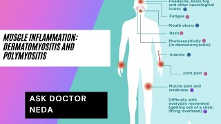 Muscle Inflammatory Disease DermatomyositisPolymyositis Diagnosis and Treatment [upl. by Anidnamra]