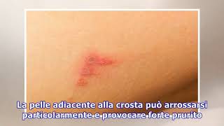 Impetigine come si prende e come si cura questa patologia della pelle [upl. by Ford]