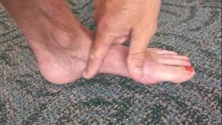 Sesamoid Evaluation and Treatments [upl. by Vas358]