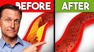 Best Nutrients to Remove Plaque from Arteries [upl. by Ydassac258]