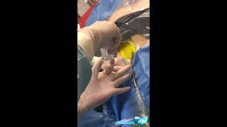 Extracorporeal CPR ECPR cannulation at IFAD2018 [upl. by Ertha]