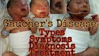 Gaucher Disease  Types symptoms diagnosis treatment  MisMedicine [upl. by Hendrix644]