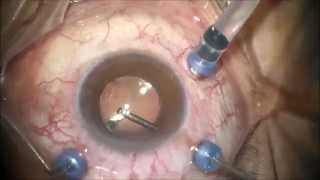 vitrectomy  uveitis [upl. by Atikat778]