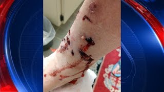 Raccoon attacks Tampa woman [upl. by Zosi113]