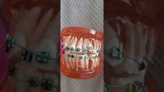 Mechanics for Premolar Extraction Cases Braces [upl. by Nnylyma]