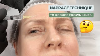 Mastering the Mesotherapy Nappage Method [upl. by Guria]