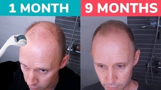 STOP BALDING  Regrow Hair Naturally with Dermaroller Real 9 Month Results [upl. by Rabin]