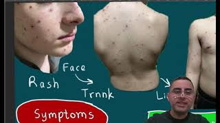 Chickenpox  Signs Symptoms Treatment How long does chicken pox last [upl. by Eimmac66]