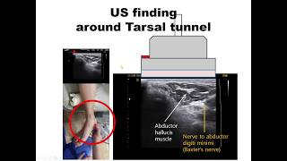 140의사용Dx amp Tx under USLecture Tarsal tunnel syndrome 족근관증후군과 주사 Kang’s method 강찬충남대Chan [upl. by Hayashi867]